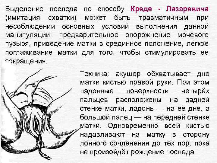 Выделение последа по способу Креде - Лазаревича (имитация схватки) может быть травматичным при несоблюдении