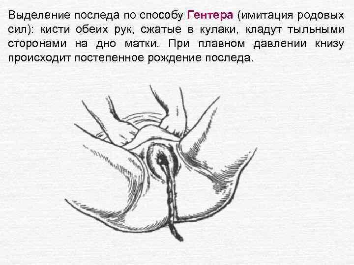 Выделение последа по способу Гентера (имитация родовых сил): кисти обеих рук, сжатые в кулаки,