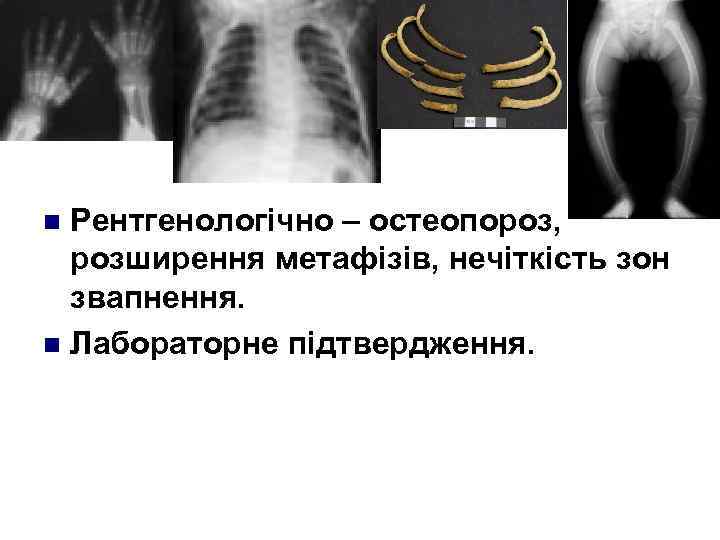 Рентгенологічно – остеопороз, розширення метафізів, нечіткість зон звапнення. n Лабораторне пiдтвердження. n 