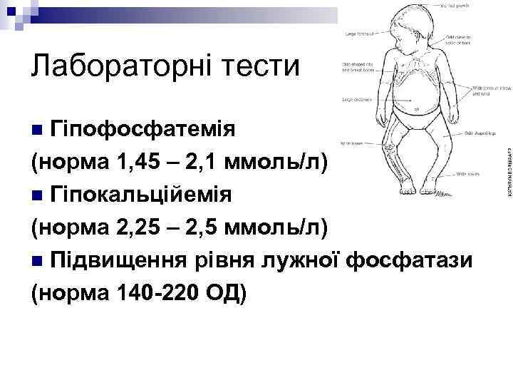 Лабораторні тести Гіпофосфатемія (норма 1, 45 – 2, 1 ммоль/л) n Гіпокальційемія (норма 2,