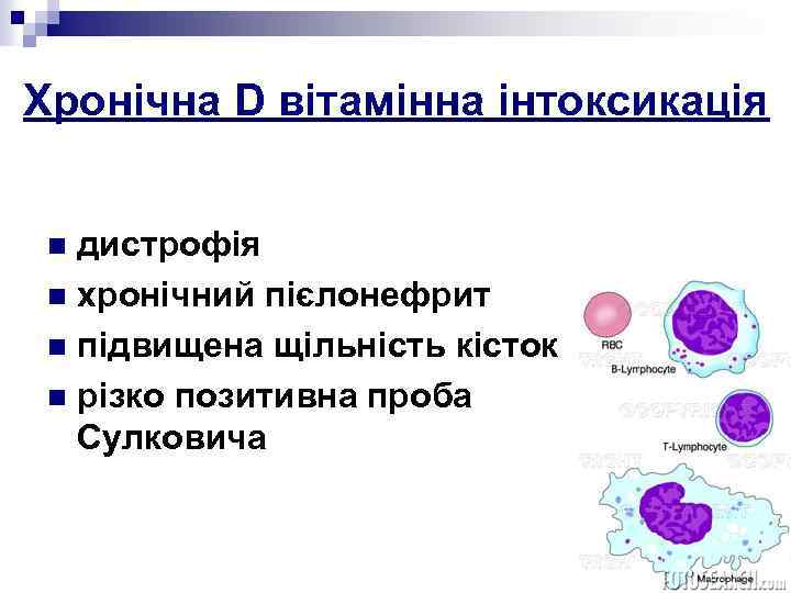 Хронічна D вітамінна інтоксикація дистрофія n хронічний пієлонефрит n підвищена щільність кісток n різко