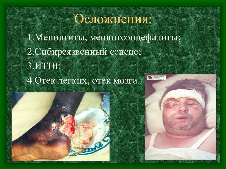Осложнения: 1. Менингиты, менингоэнцефалиты; 2. Сибиреязвенный сепсис; 3. ИТШ; 4. Отек легких, отек мозга.