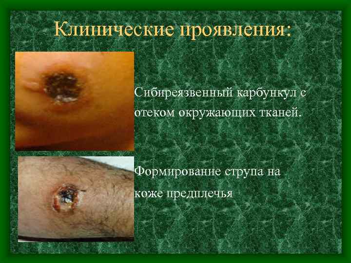 Клинические проявления: Сибиреязвенный карбункул с отеком окружающих тканей. Формирование струпа на коже предплечья 