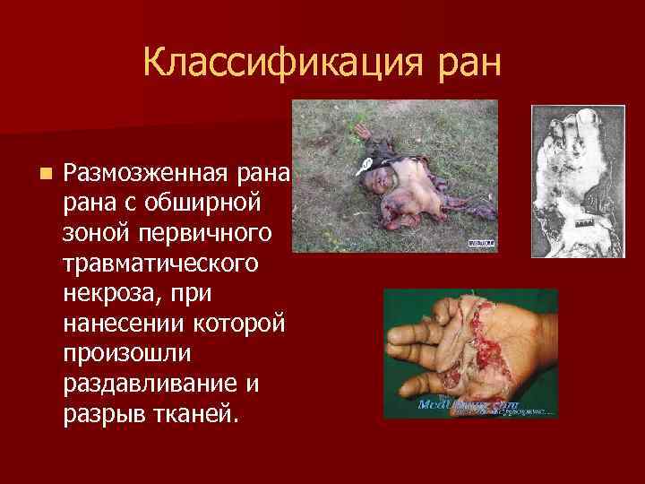 Классификация ран n Размозженная рана с обширной зоной первичного травматического некроза, при нанесении которой