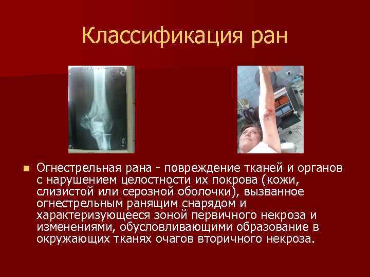 Классификация ран n Огнестрельная рана - повреждение тканей и органов с нарушением целостности их