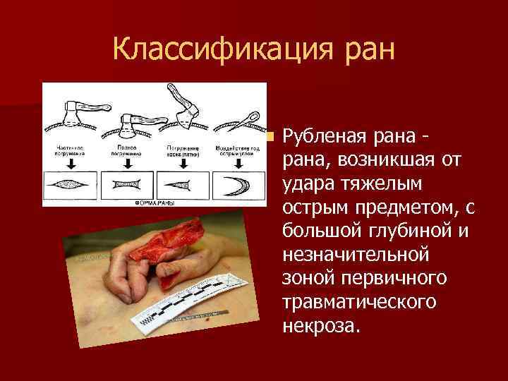 Классификация ран n Рубленая рана, возникшая от удара тяжелым острым предметом, с большой глубиной