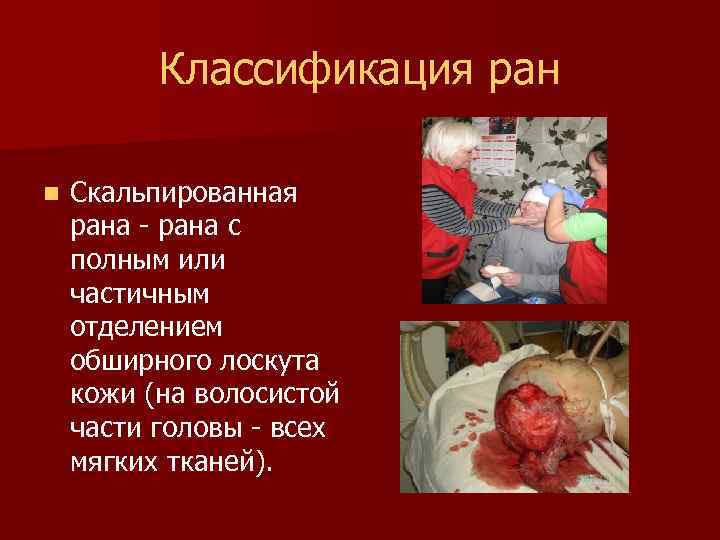 Классификация ран n Скальпированная рана - рана с полным или частичным отделением обширного лоскута