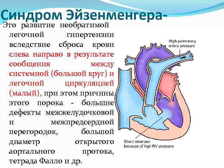 Синдромнеобратимой Эйзенменгера. Это развитие легочной гипертензии вследствие сброса крови слева направо в результате сообщения