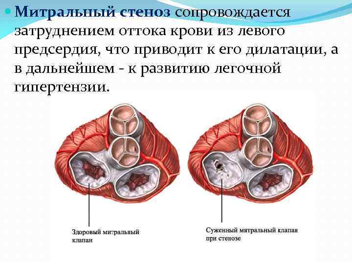 Фото митральный стеноз