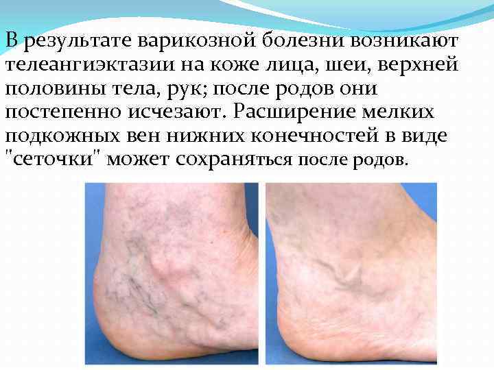 В результате варикозной болезни возникают телеангиэктазии на коже лица, шеи, верхней половины тела, рук;