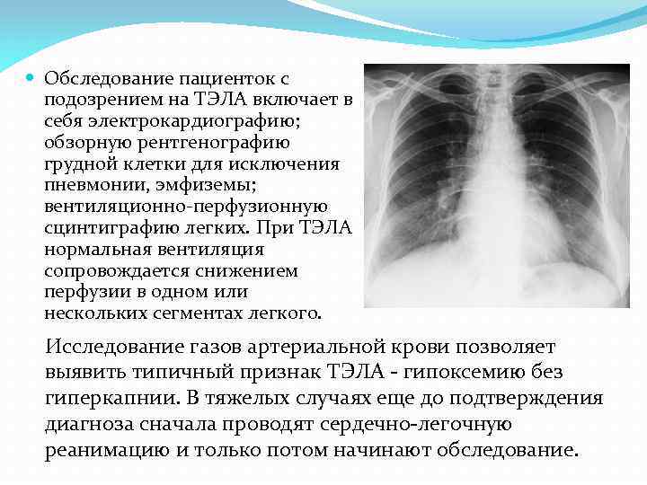  Обследование пациенток с подозрением на ТЭЛА включает в себя электрокардиографию; обзорную рентгенографию грудной