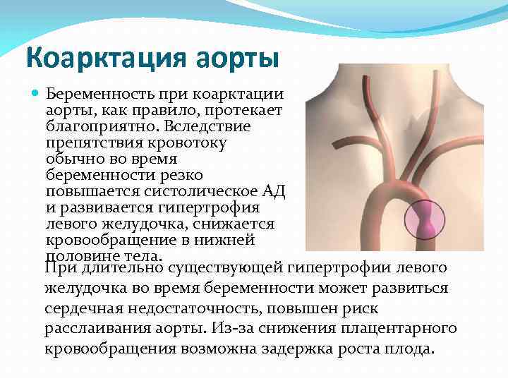 Коарктация аорты Беременность при коарктации аорты, как правило, протекает благоприятно. Вследствие препятствия кровотоку обычно