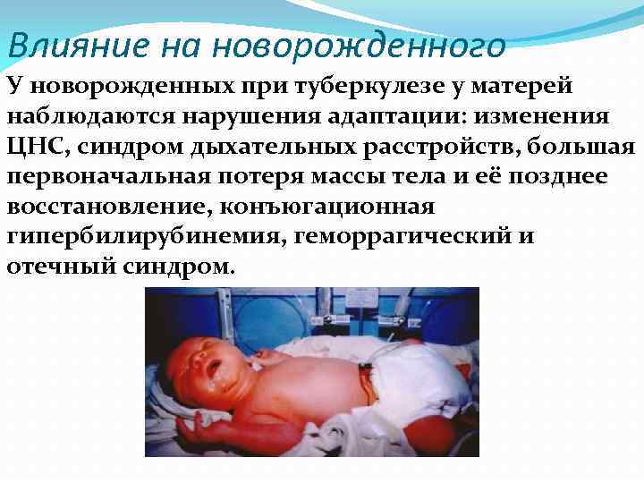 Влияние на новорожденного У новорожденных при туберкулезе у матерей наблюдаются нарушения адаптации: изменения ЦНС,
