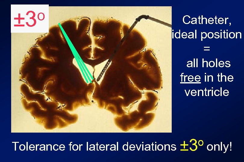 o ± 3 Catheter, ideal position = all holes free in the ventricle o
