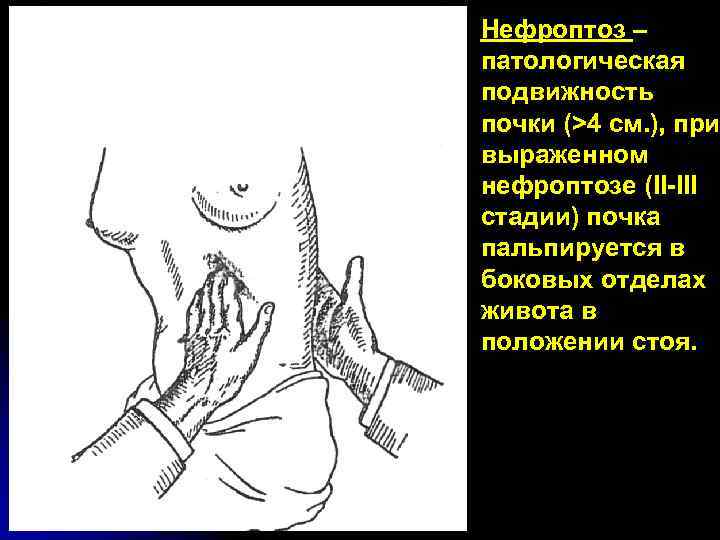 Нефроптоз – патологическая подвижность почки (>4 см. ), при выраженном нефроптозе (II-III стадии) почка