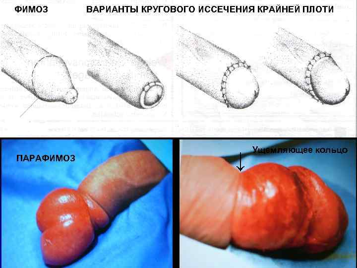 ФИМОЗ ПАРАФИМОЗ ВАРИАНТЫ КРУГОВОГО ИССЕЧЕНИЯ КРАЙНЕЙ ПЛОТИ ↓ Ущемляющее кольцо 