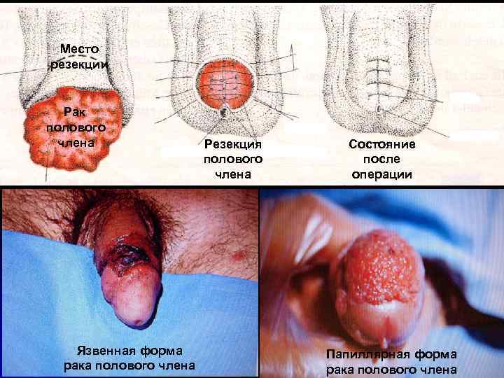 Место резекции Рак полового члена Язвенная форма рака полового члена Резекция полового члена Состояние