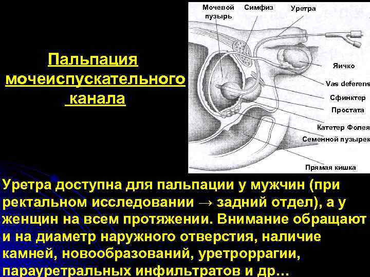 Мочевой пузырь Пальпация мочеиспускательного канала Симфиз Уретра Яичко Vas deferens Сфинктер Простата Катетер Фолея