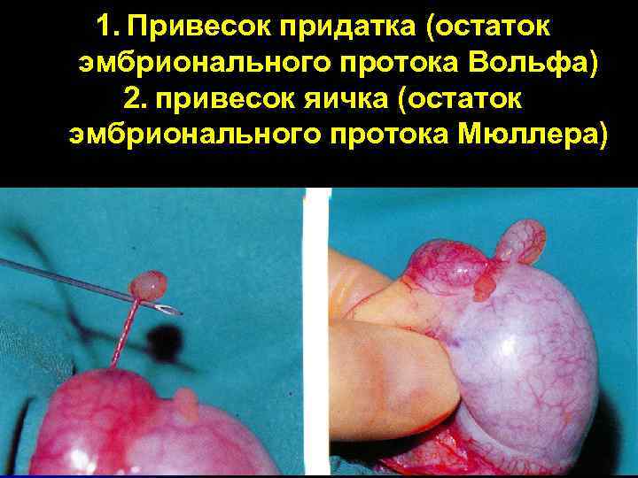 1. Привесок придатка (остаток эмбрионального протока Вольфа) 2. привесок яичка (остаток эмбрионального протока Мюллера)