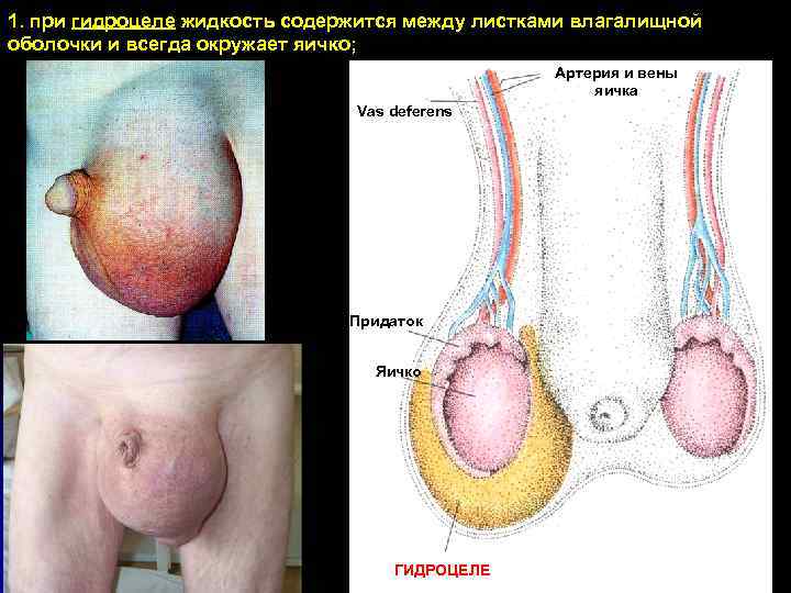 1. при гидроцеле жидкость содержится между листками влагалищной оболочки и всегда окружает яичко; Артерия