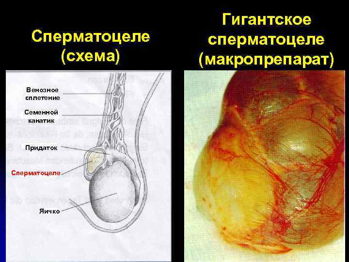 Сперматоцеле (схема) Венозное сплетение Семенной канатик Придаток Сперматоцеле Яичко Гигантское сперматоцеле (макропрепарат) 