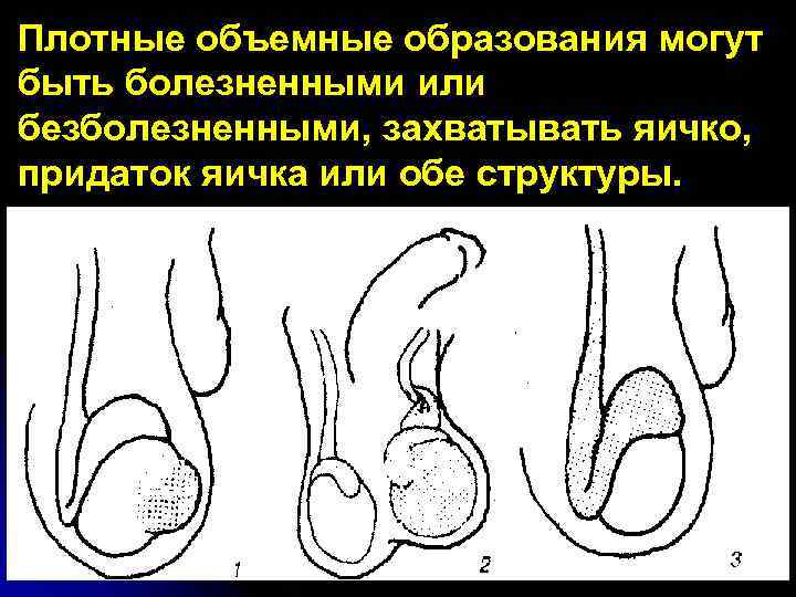 Плотные объемные образования могут быть болезненными или безболезненными, захватывать яичко, придаток яичка или обе