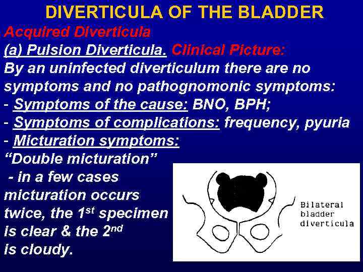 DIVERTICULA OF THE BLADDER Acquired Diverticula (a) Pulsion Diverticula. Clinical Picture: By an uninfected