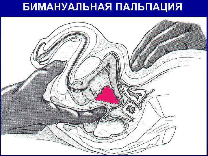 БИМАНУАЛЬНАЯ ПАЛЬПАЦИЯ 