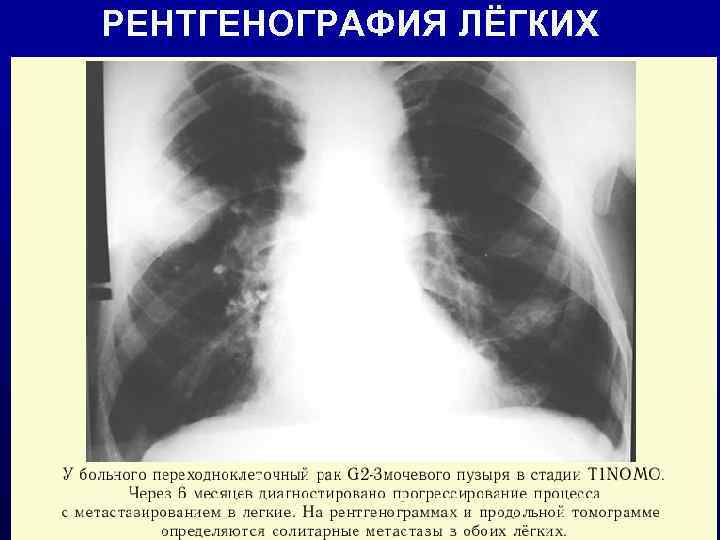 РЕНТГЕНОГРАФИЯ ЛЁГКИХ 