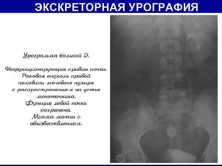 ЭКСКРЕТОРНАЯ УРОГРАФИЯ 