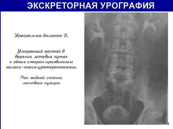 ЭКСКРЕТОРНАЯ УРОГРАФИЯ 
