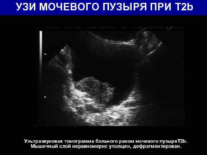 УЗИ МОЧЕВОГО ПУЗЫРЯ ПРИ T 2 b 