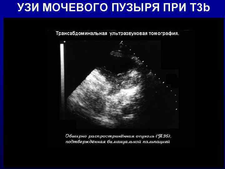 УЗИ МОЧЕВОГО ПУЗЫРЯ ПРИ Т 3 b 