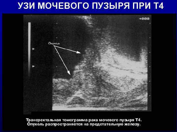 УЗИ МОЧЕВОГО ПУЗЫРЯ ПРИ Т 4 