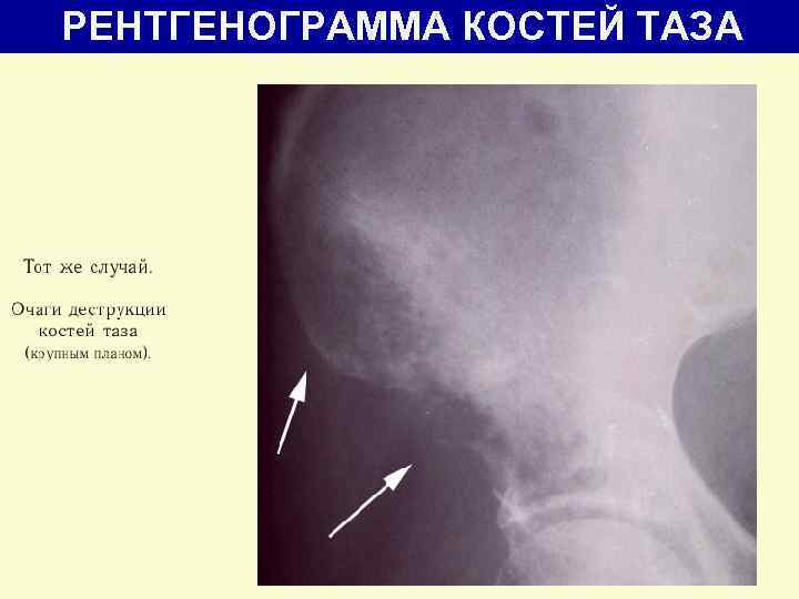 РЕНТГЕНОГРАММА КОСТЕЙ ТАЗА 
