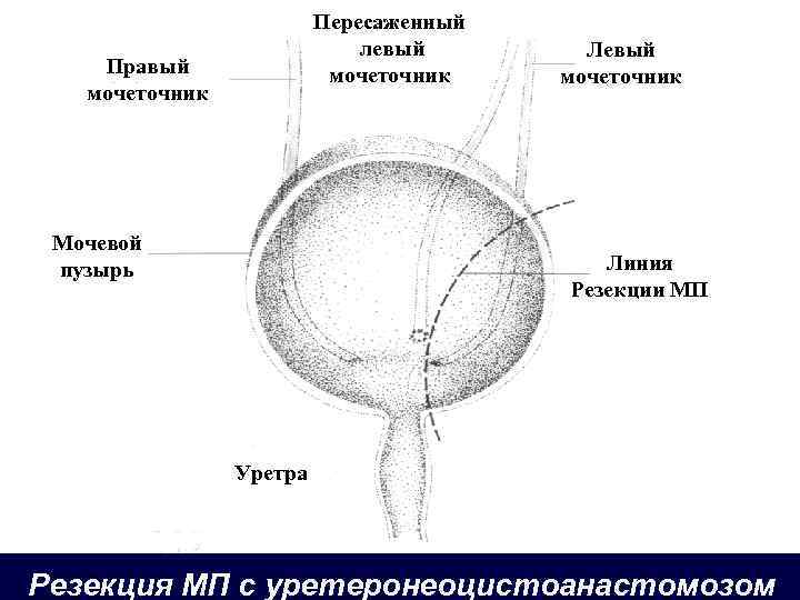 Пересаженный левый мочеточник Правый мочеточник Мочевой пузырь Левый мочеточник Линия Резекции МП Уретра Резекция