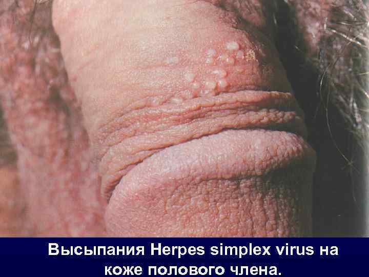 Высыпания Herpes simplex virus на коже полового члена. 