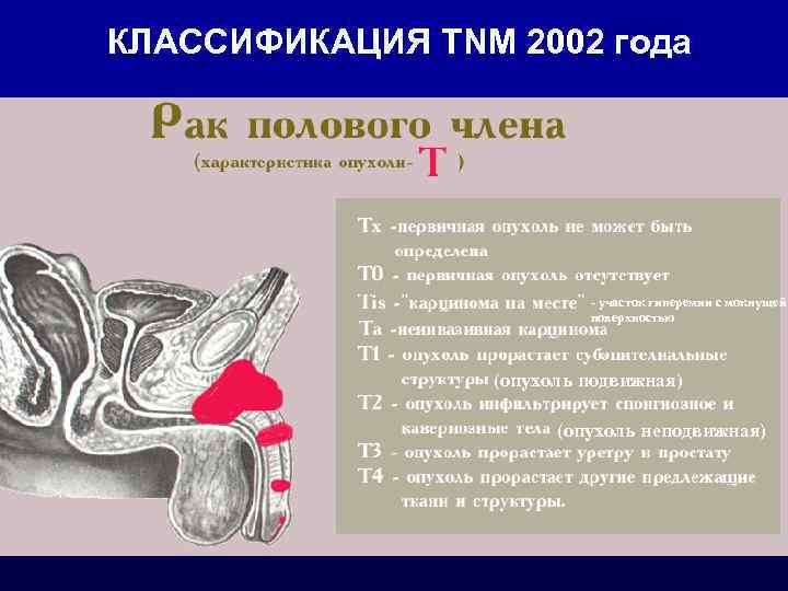 КЛАССИФИКАЦИЯ TNM 2002 года - участок гиперемии с мокнущей поверхностью (опухоль подвижная) (опухоль неподвижная)