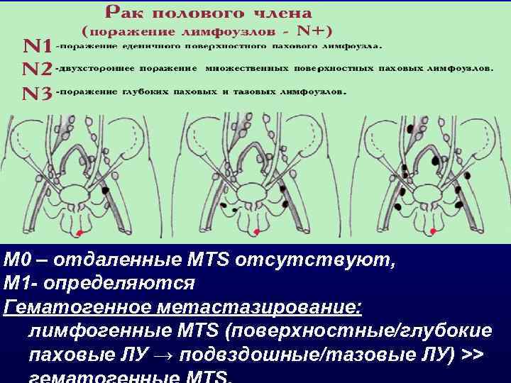 M 0 – отдаленные MTS отсутствуют, М 1 - определяются Гематогенное метастазирование: лимфогенные MTS