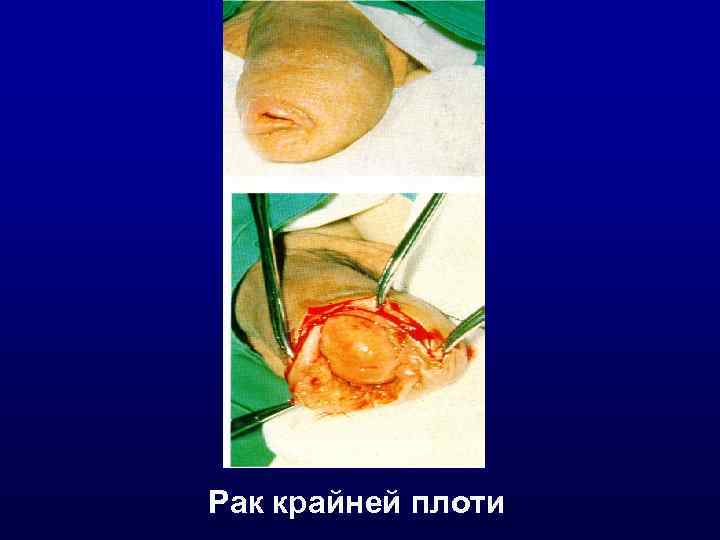 Рак крайней плоти 