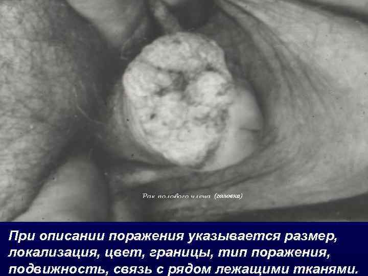 (головка) При описании поражения указывается размер, локализация, цвет, границы, тип поражения, подвижность, связь с