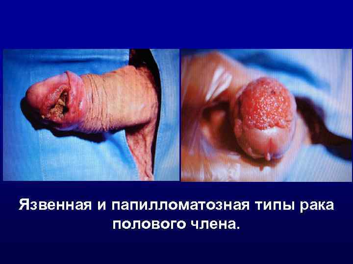Язвенная и папилломатозная типы рака полового члена. 