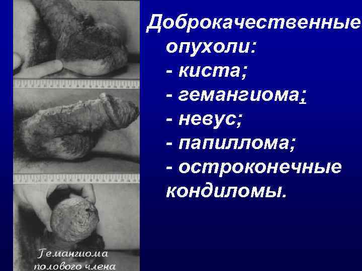 Доброкачественные опухоли: - киста; - гемангиома; - невус; - папиллома; - остроконечные кондиломы. 