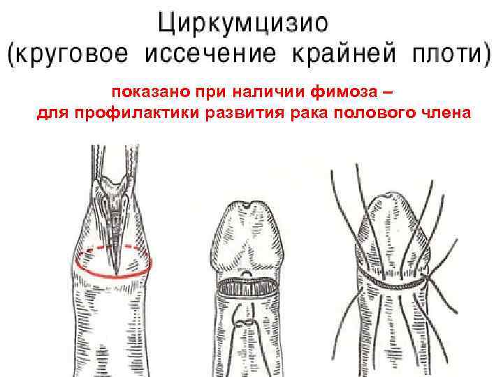 показано при наличии фимоза – для профилактики развития рака полового члена 