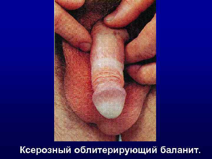 Ксерозный облитерирующий баланит. 