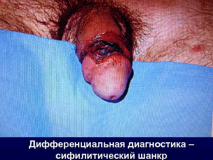 Дифференциальная диагностика – сифилитический шанкр 