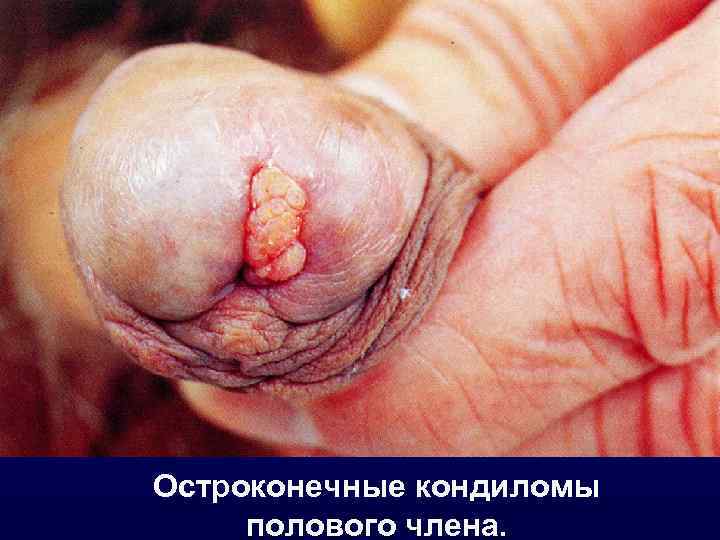 Остроконечные кондиломы полового члена. 