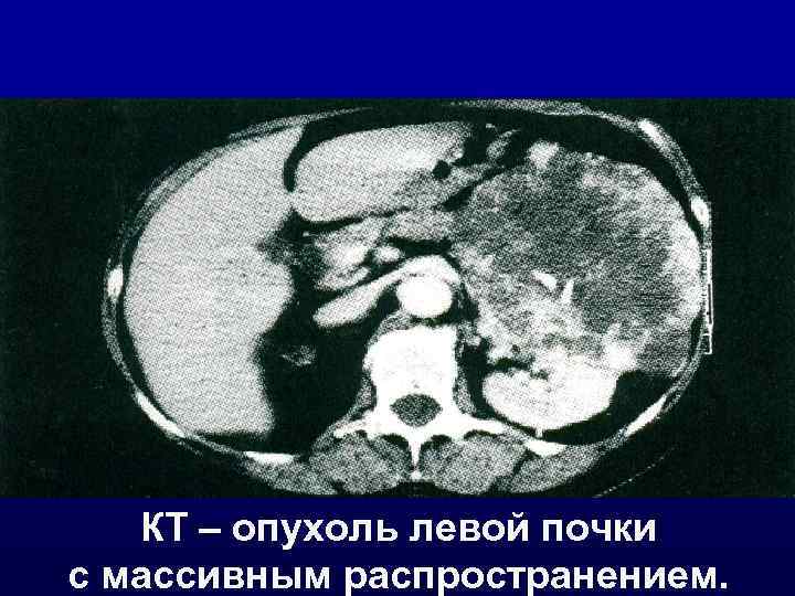 КТ – опухоль левой почки с массивным распространением. 