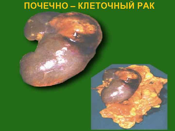 ПОЧЕЧНО – КЛЕТОЧНЫЙ РАК 