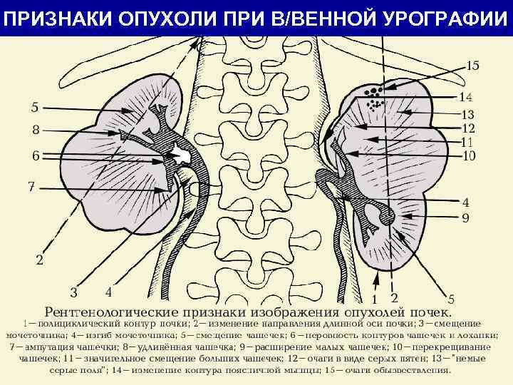ПРИЗНАКИ ОПУХОЛИ ПРИ В/ВЕННОЙ УРОГРАФИИ 